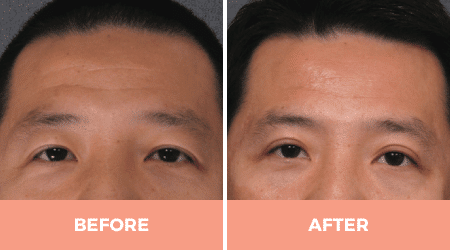 Asian Eyelid Surgery Sydney Asian Blepharoplasty Double Eyelid Surgery